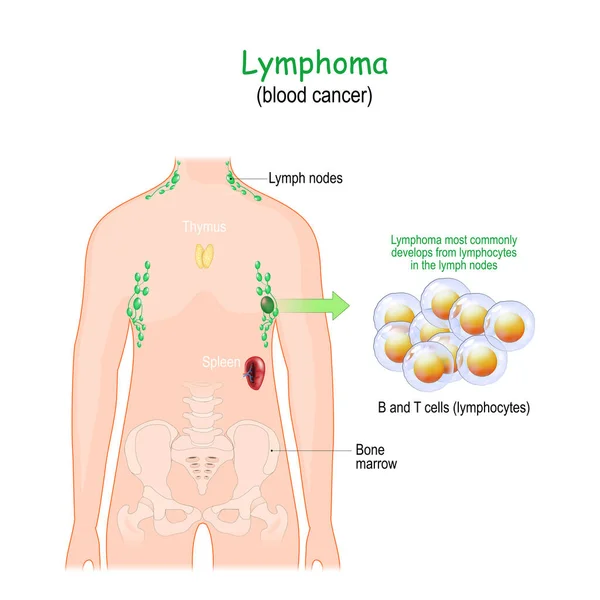 Lymfom Eller Blodcancer Människans Kropp Med Lymfsystemet Närbild Vita Blodkroppar — Stock vektor