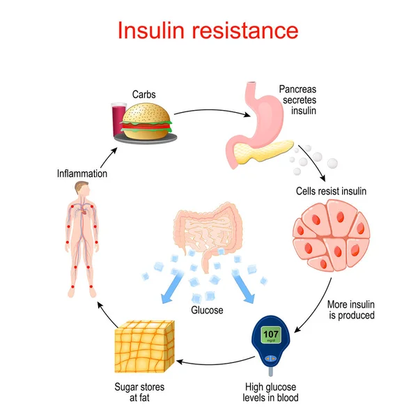 Resistenza All Insulina Condizione Patologica Cui Cellule Non Rispondono Normalmente — Vettoriale Stock