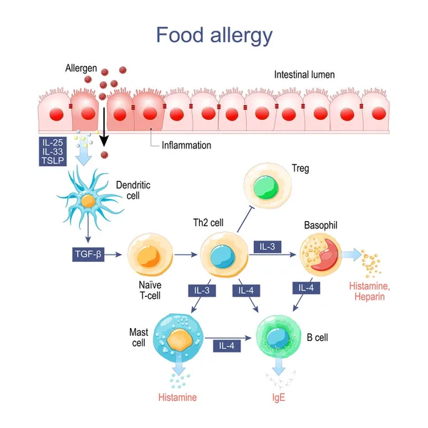 Alergia Alimentar Inflamação Intestino Alérgenos Histamina Células Imunes Que Liberam — Vetor de Stock