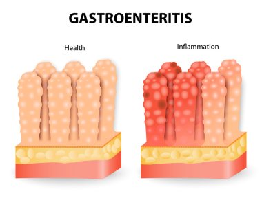 Gastroenteritis or infectious diarrhea clipart