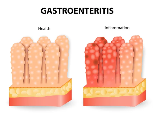 Gastroenterite o diarrea infettiva — Vettoriale Stock