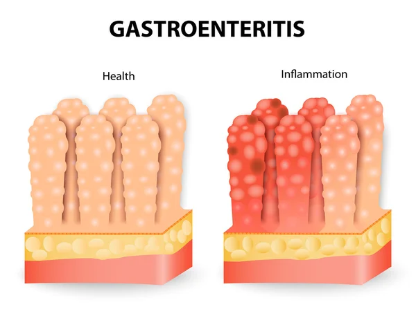 胃肠炎或感染性腹泻 — 图库矢量图片