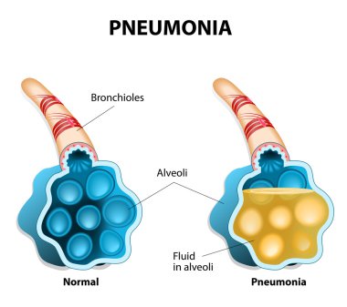 Pneumonia. Illustration shows normal and infected alveoli. clipart
