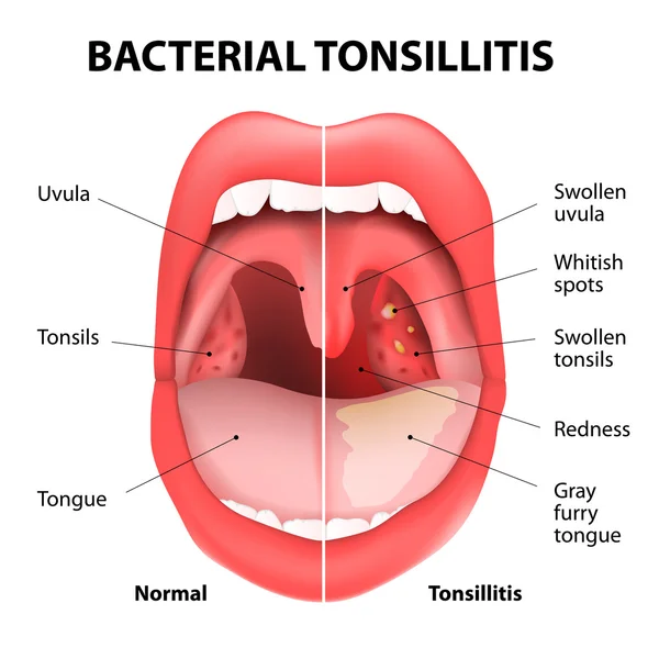 Amigdalitis bacteriana — Vector de stock