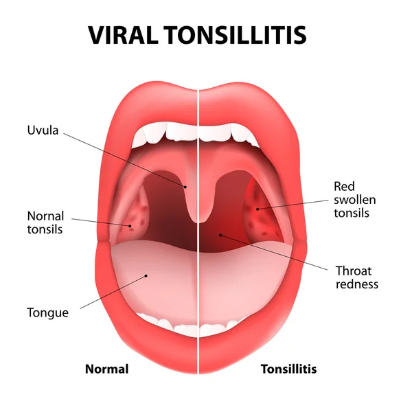 676 Tonsil Vector Images Free Royalty Free Tonsil Vectors Depositphotos
