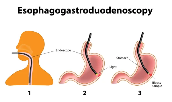 以胃肠或 oesophagogastroduodenoscopy 或长柄锅 — 图库矢量图片