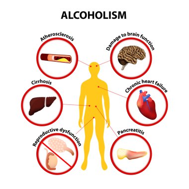 alkolizm. Infographic