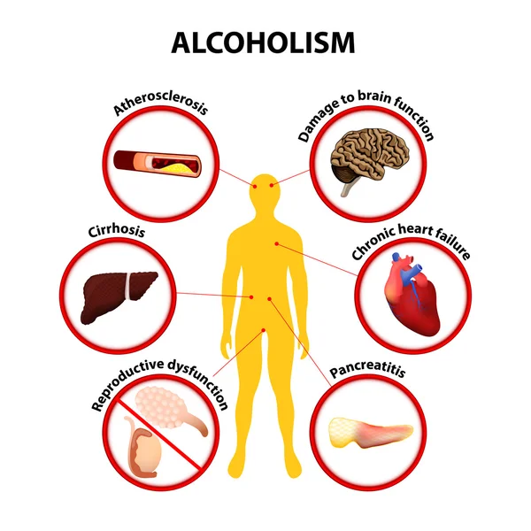 Alkoholismus. Infographic — Stockový vektor