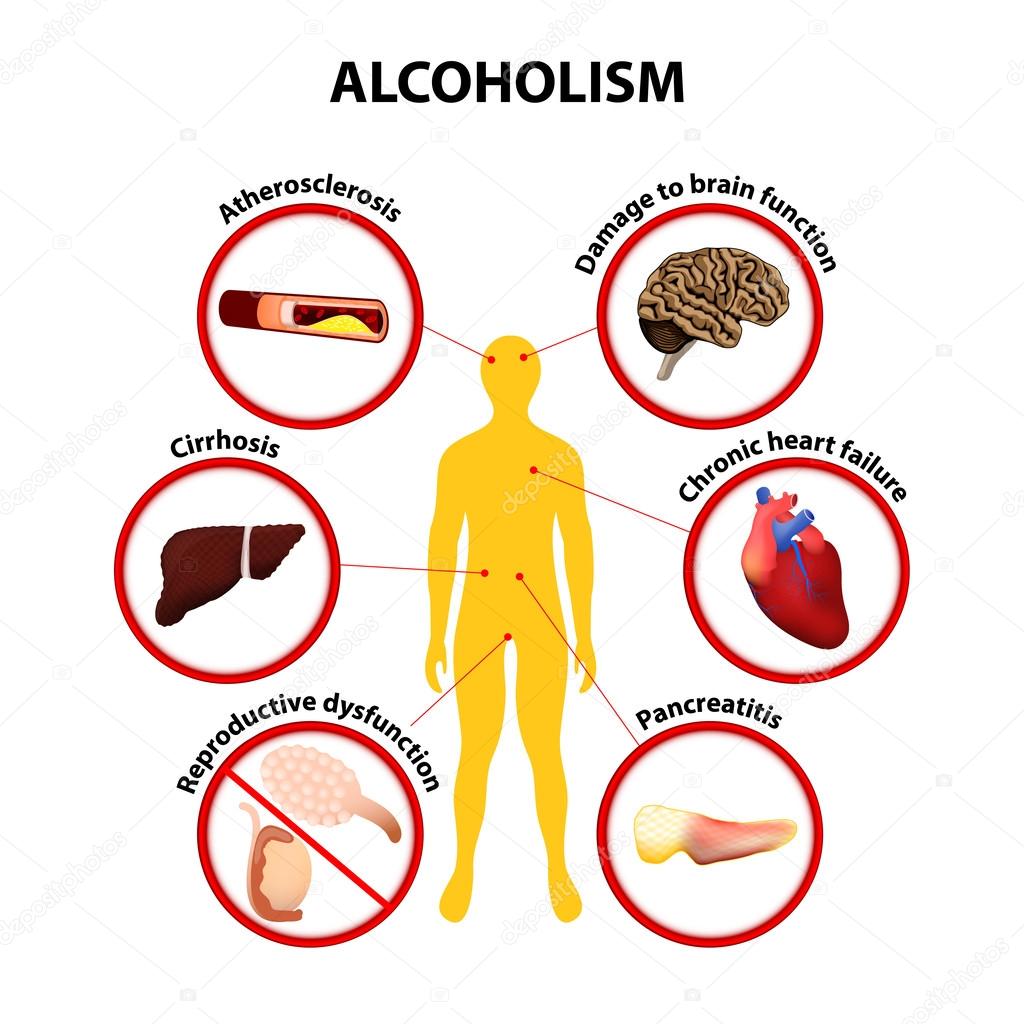 Alcoholismo. infografía Stock Vector by ©edesignua 53043777