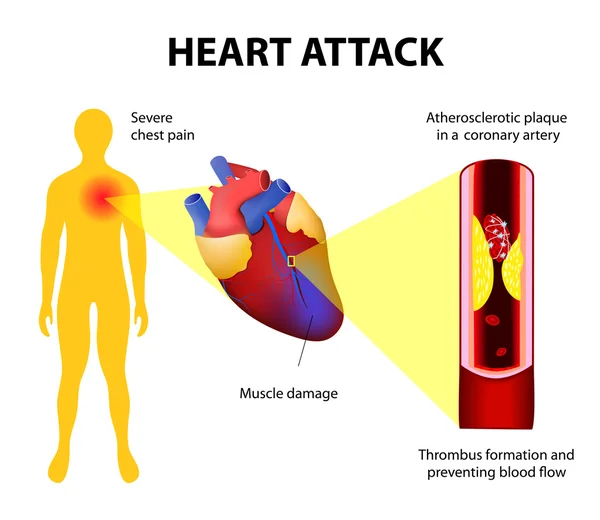 Crise cardiaque — Image vectorielle