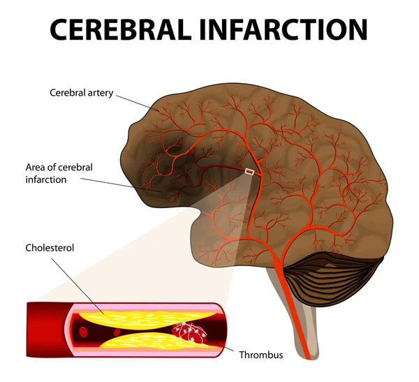 Infarto cerebrale o ictus ischemico — Vettoriale Stock