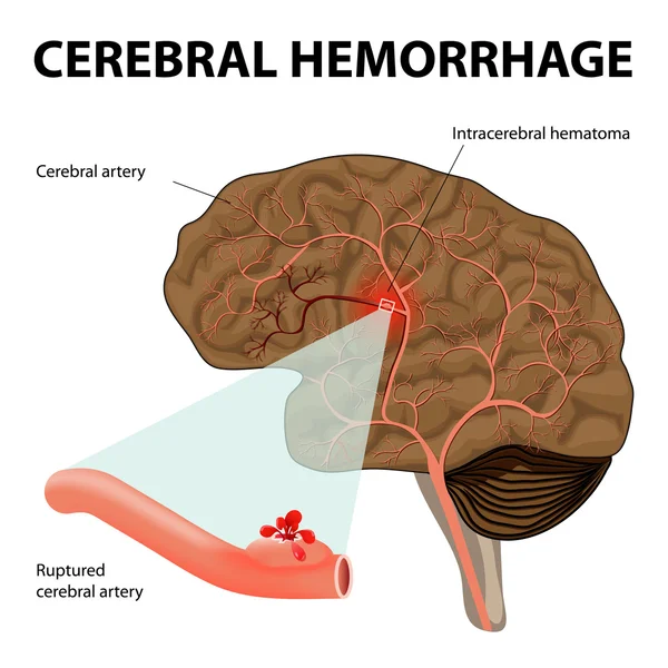 Hemorragia cerebral — Vetor de Stock