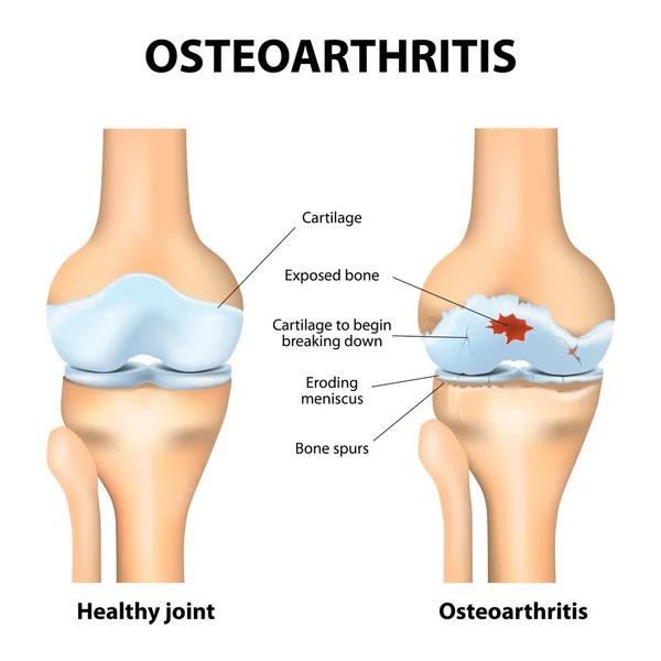 Osteoarthritis vagy ízületi gyulladás — Stock Vector