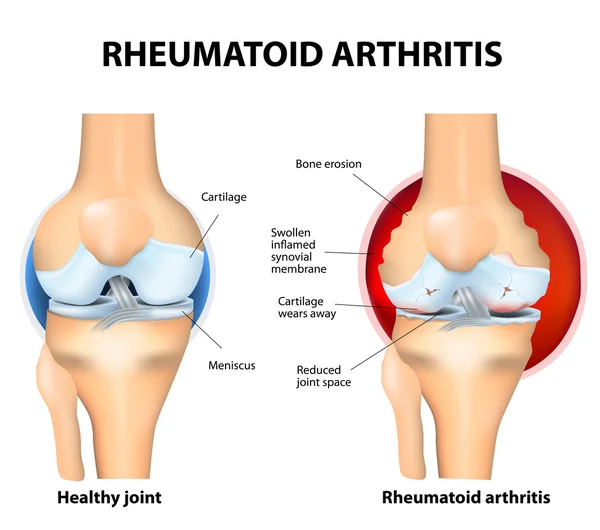 Normál közös és a rheumatoid arthritis — Stock Vector