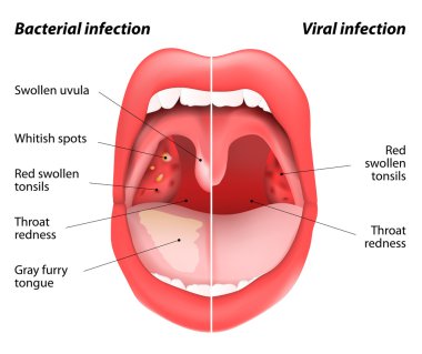 The differences between viral and bacterial infections clipart
