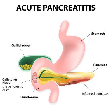 Acute pancreatitis clipart