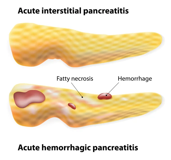 Pancreatitis aguda — Vector de stock