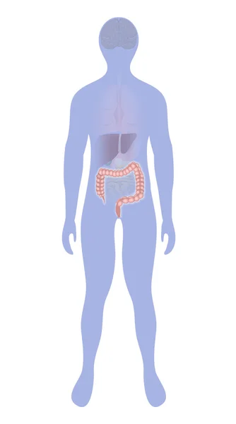 大肠癌在一个人的轮廓上突出显示 — 图库矢量图片