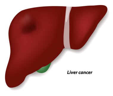 Liver cancer clipart