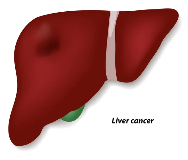 Cáncer de hígado — Archivo Imágenes Vectoriales