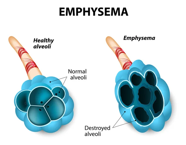 EMFISEMA — Archivo Imágenes Vectoriales