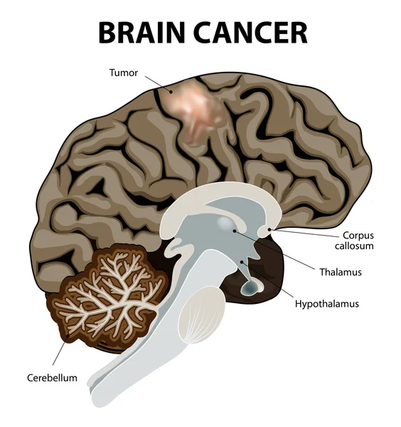 Rakovina mozku — Stockový vektor