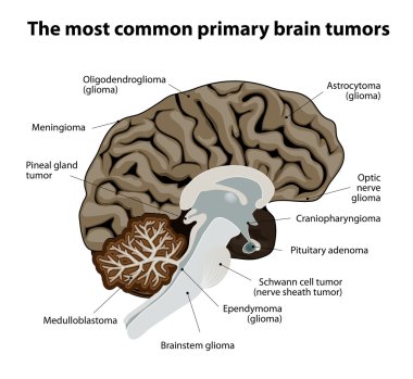The most common primary brain tumors clipart