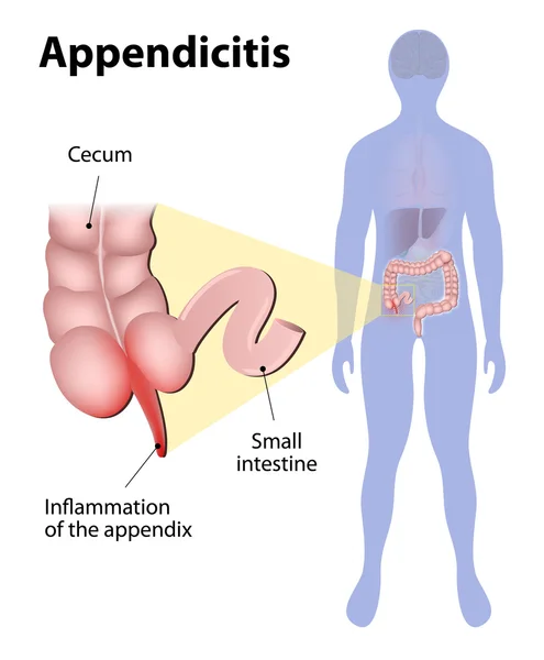 Apendicitis — Vector de stock