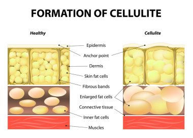 Formation of cellulite clipart