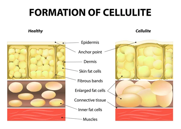 Formación de celulitis — Vector de stock