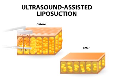 Ultrason destekli liposuction