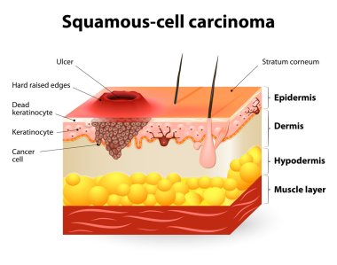 Squamous cell carcinoma clipart
