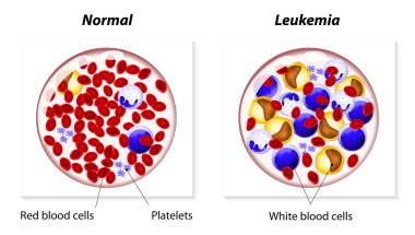 Leukemia or leukaemia clipart