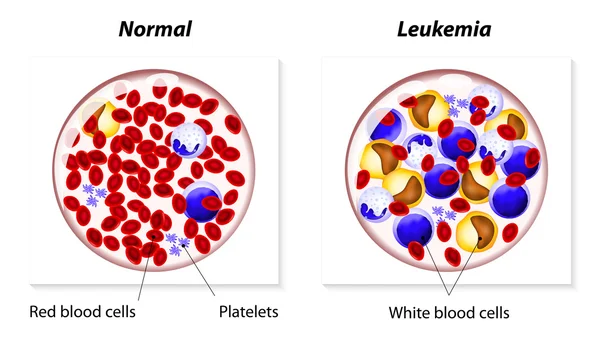 Leukemia or leukaemia — Stock Vector