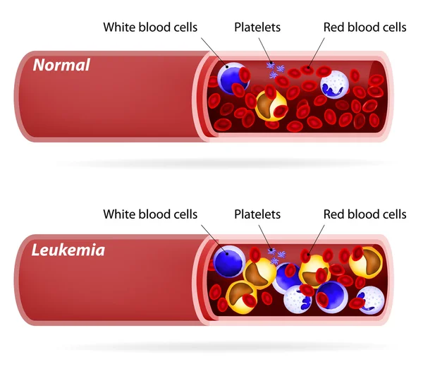 Cancer. Leukemia or leukaemia — Stock Vector