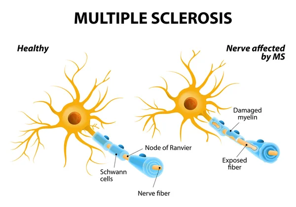 Sclerosis multiplex — Stock Vector