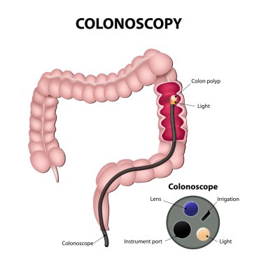 Colonoscopy clipart