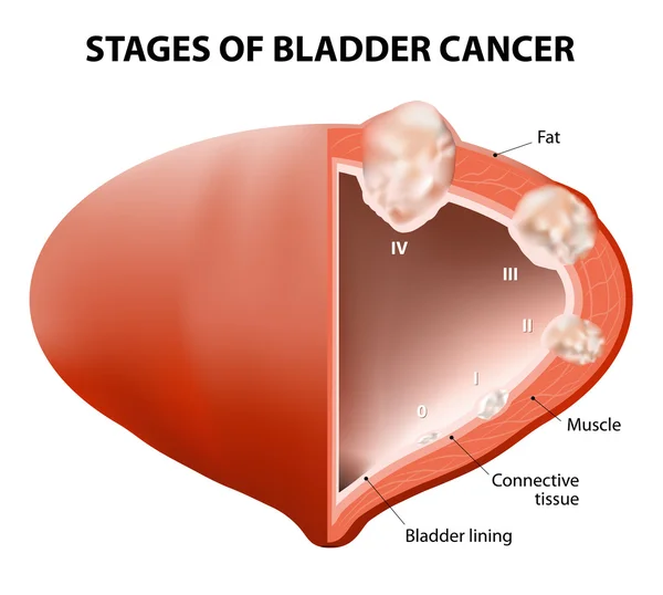 Cáncer de vejiga — Vector de stock