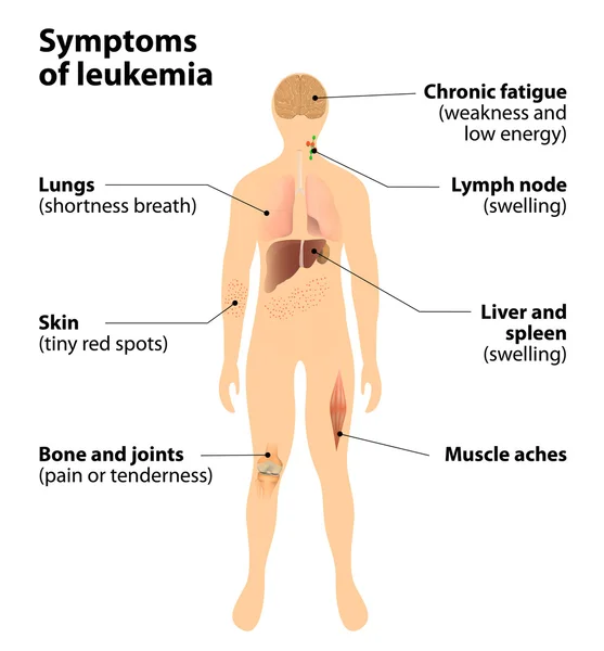 Sintomas de leucemia. cancro do sangue — Vetor de Stock