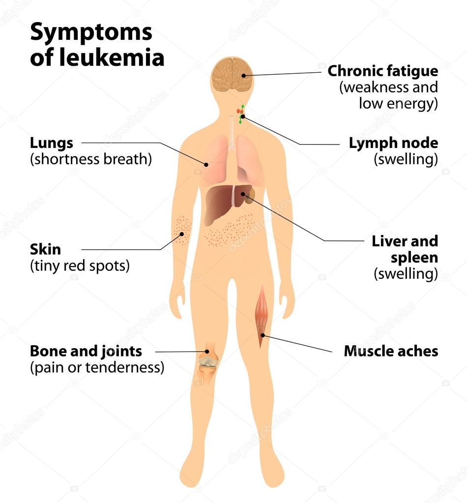 symptoms of  leukemia. blood cancer