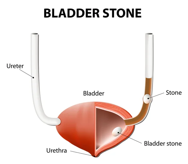 Stenar i urinblåsan och urinledaren — Stock vektor