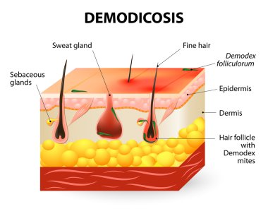 demodicosis. Demodex akar
