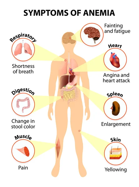 Symptoms of anemia — Stock Vector