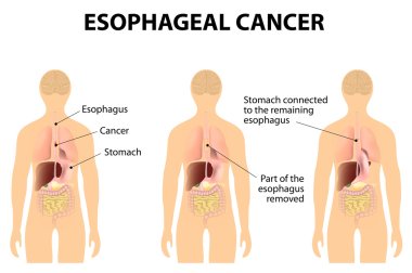 Esophageal Cancer clipart