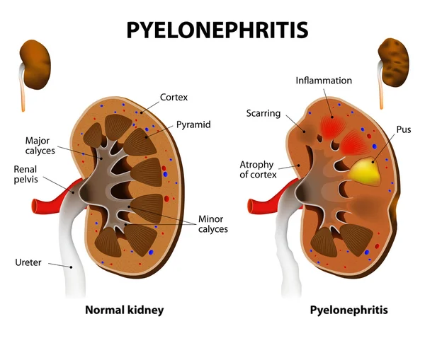Pyelonephritis — Stockový vektor