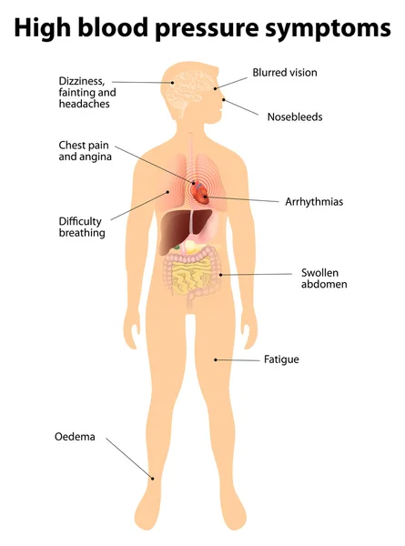 Sintomas de hipertensão. tensão arterial elevada — Vetor de Stock