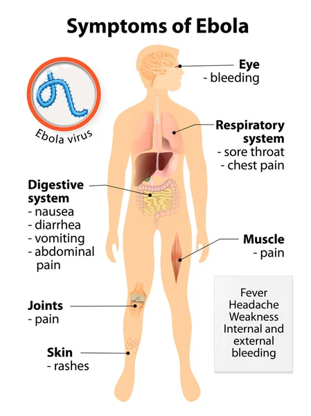 Malattia da virus dell'ebola — Vettoriale Stock