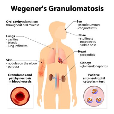Granülomatoz