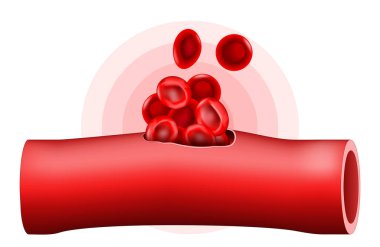 Hematoma. Blood vessel after trauma. Close-up of Red blood cell. Localized bleeding outside of blood vessel. Vector illustration