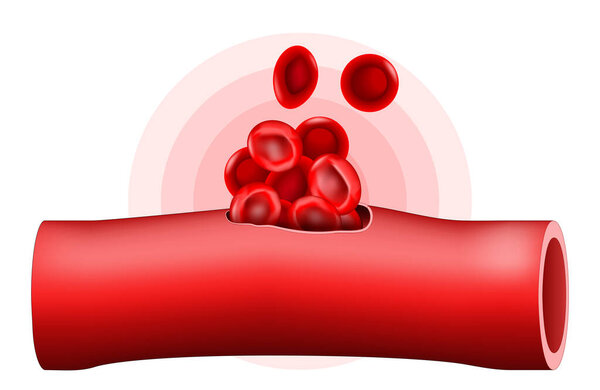 Hematoma. Blood vessel after trauma. Close-up of Red blood cell. Localized bleeding outside of blood vessel. Vector illustration